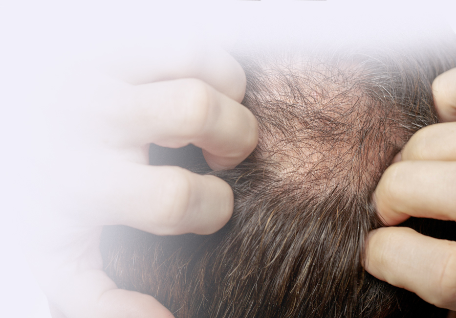 Minoxidil